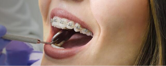 BRACES FOR ADULTS