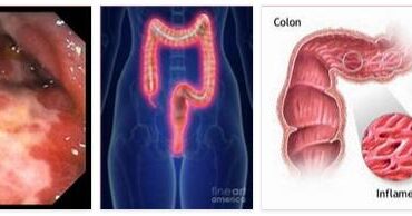 Colon Inflammation