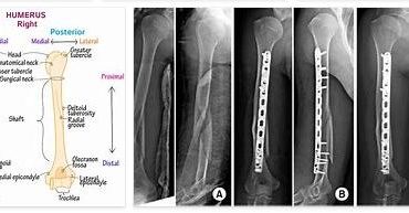 Humeral Shaft Fracture